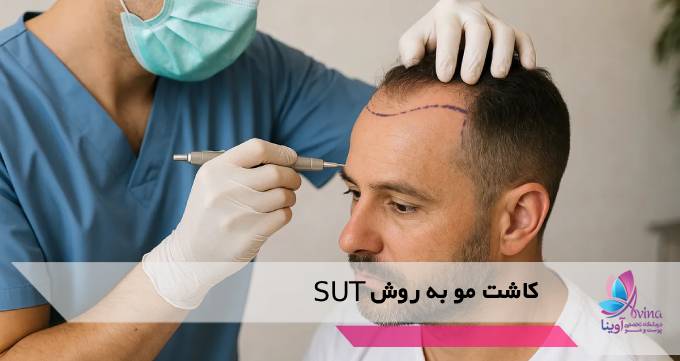 کاشت مو به روش SUT
