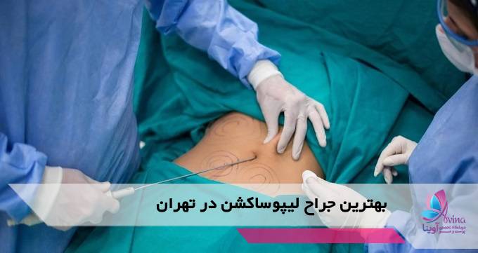 بهترین جراح لیپوساکشن در تهران