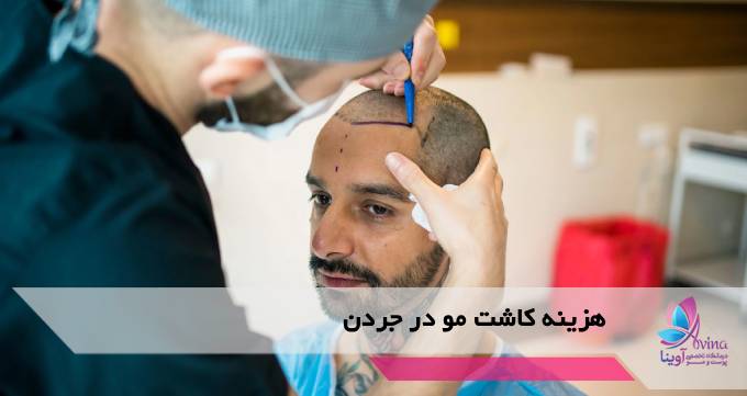 هزینه کاشت مو در جردن