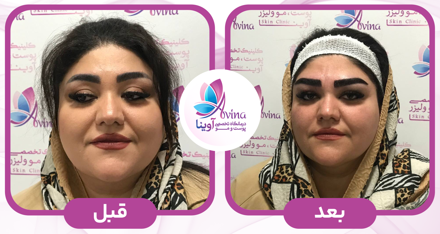 کاشت ابرو در کلینیک آوینا