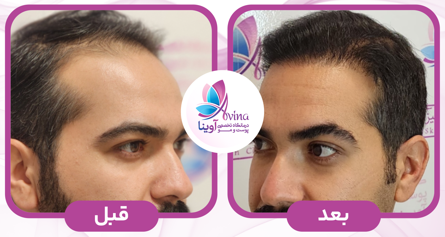 ویژگیهای بهترین دکتر کاشت مو در تهران