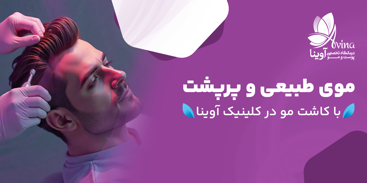 کاشت مو در کلینیک آوینا