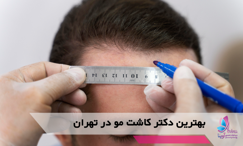 بهترین دکتر کاشت مو در تهران