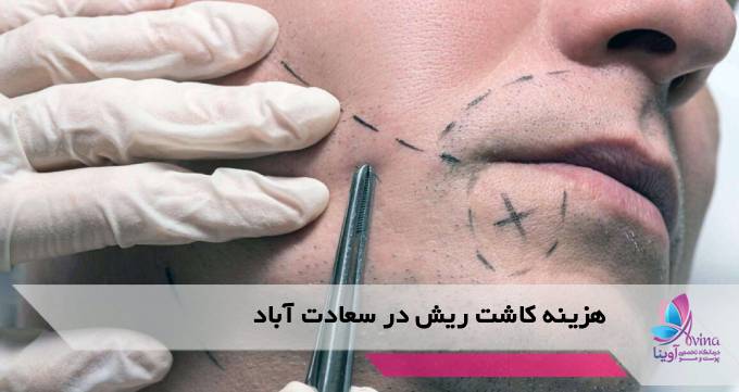 هزینه کاشت ریش در سعادت آباد