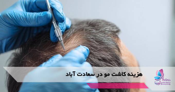 هزینه کاشت مو در سعادت آباد