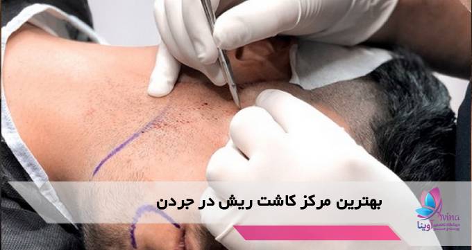بهترین مرکز کاشت ریش در جردن