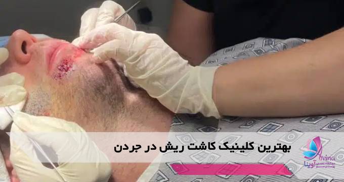 بهترین کلینیک کاشت ریش در جردن