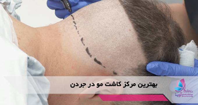 بهترین مرکز کاشت مو در جردن