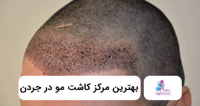 بهترین مرکز کاشت مو در جردن ⭐【سال1405】❤️