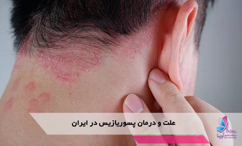 علت و درمان پسوریازیس در ایران