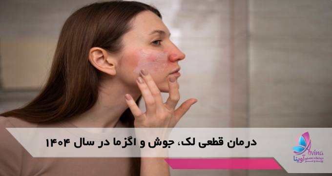 درمان قطعی لک، جوش و اگزما در سال 1405