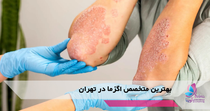بهترین متخصص اگزما در تهران