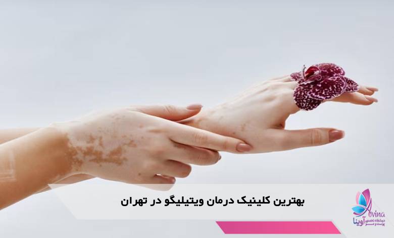 بهترین کلینیک درمان ویتیلیگو در تهران