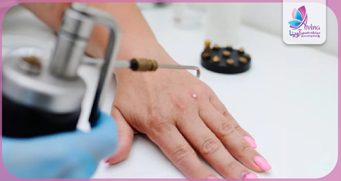 کرایوتراپی فریز کردن زگیلهای کوچک