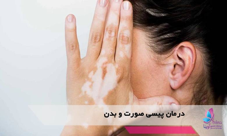 درمان پیسی صورت و بدن