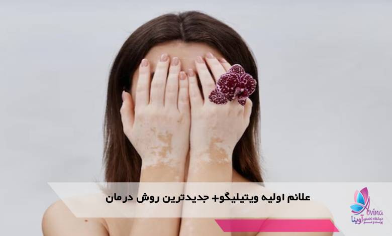 علائم اولیه ویتیلیگو+ جدیدترین روش درمان