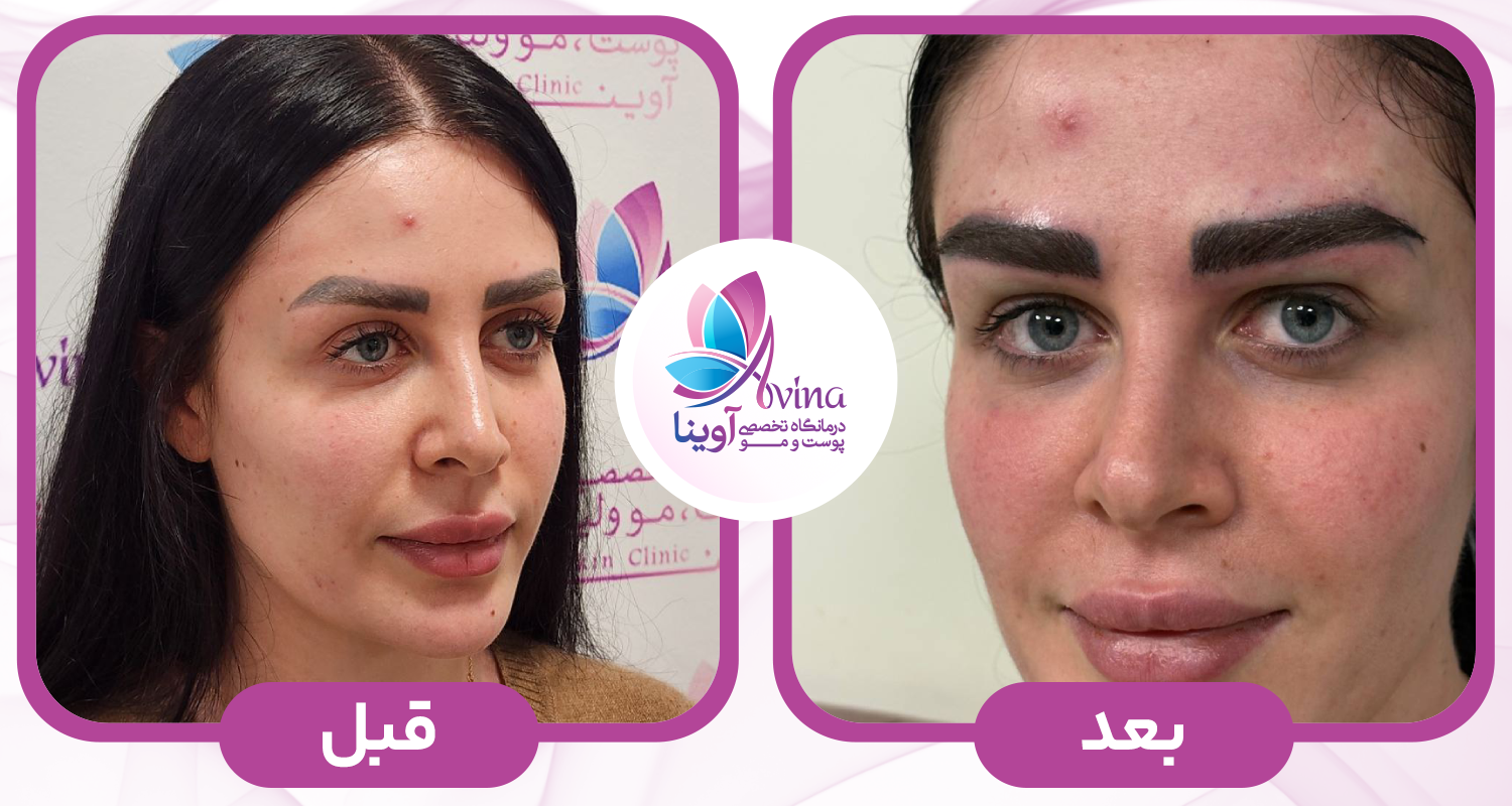 مزایای کاشت ابرو