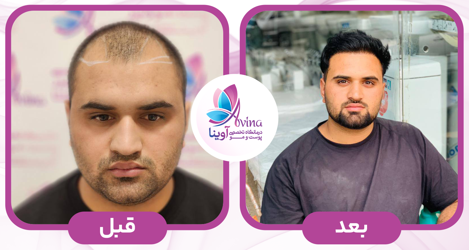 کاشت مو در کلینیک آوینا