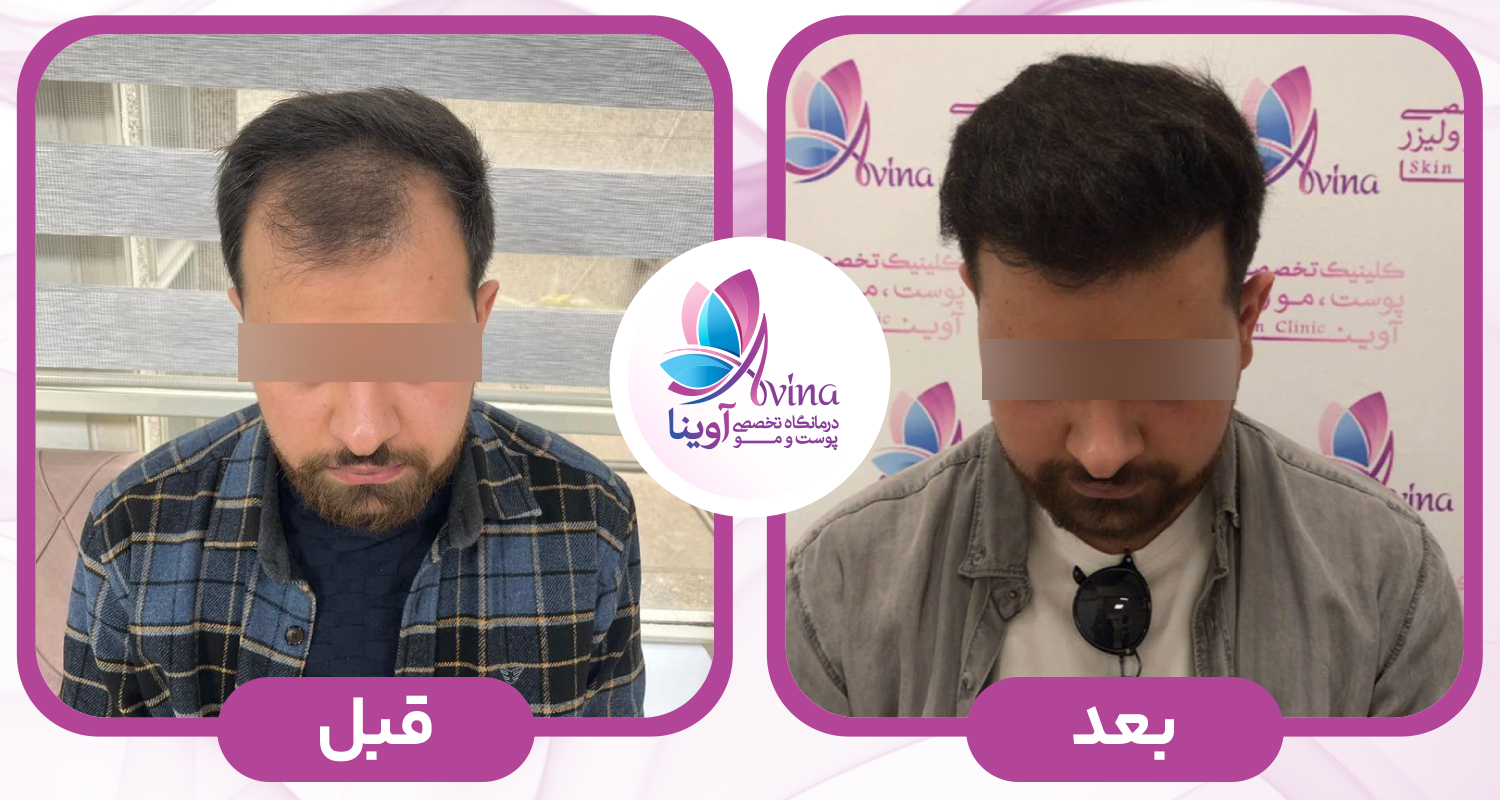 کاشت مو در کلینیک آوینا