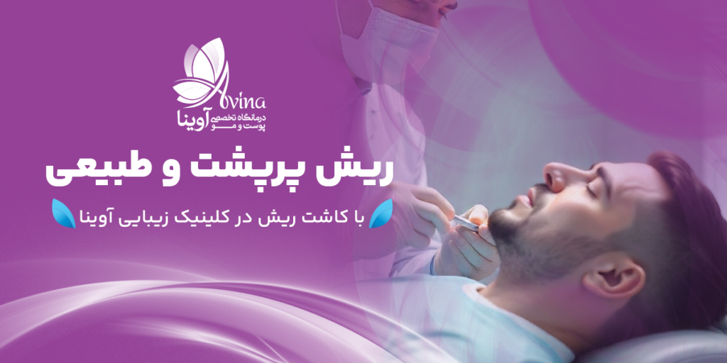 کاشت ریش