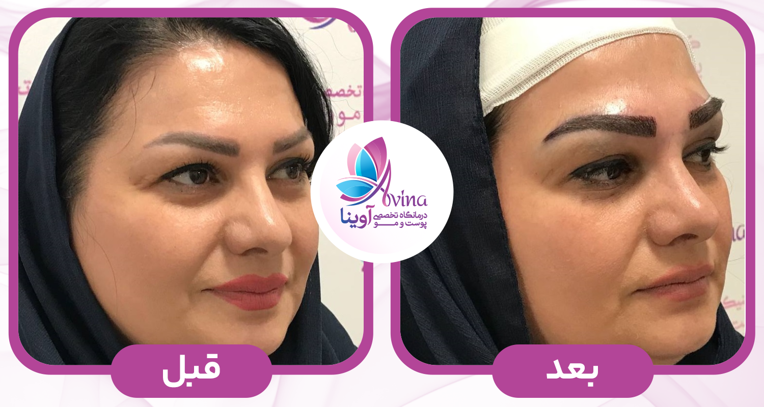 کاشت ابرو در کلینیک آوینا