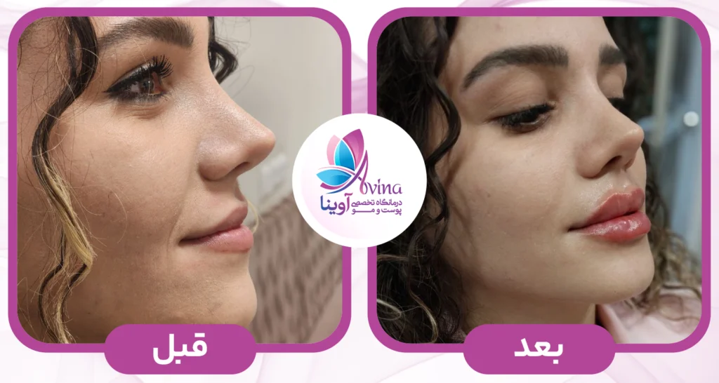 تزریق ژل در کلینیک آوینا