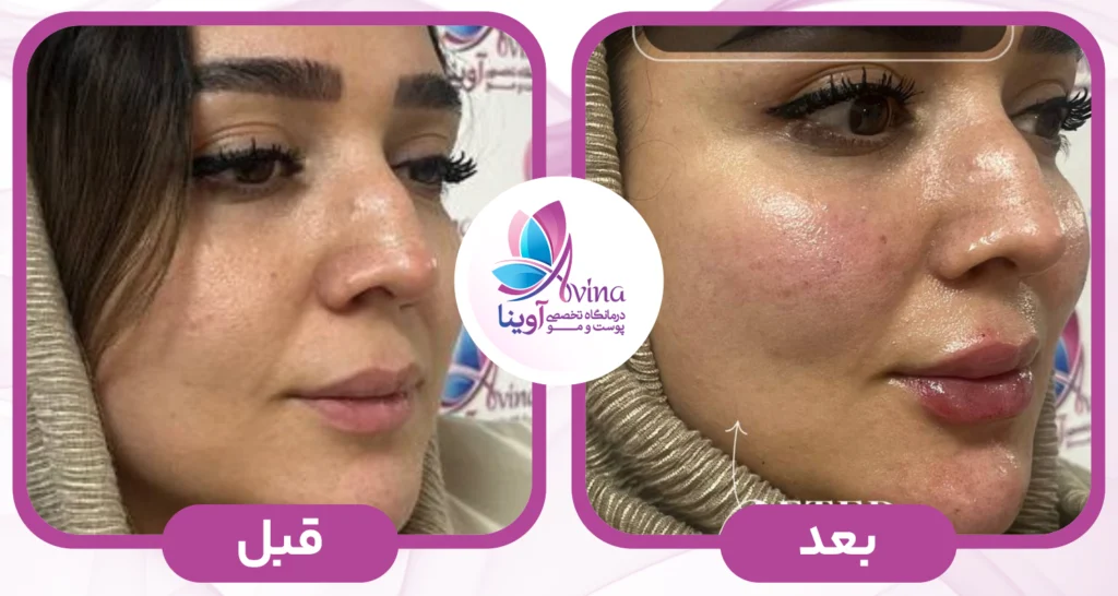 تزریق ژل در کلینیک آوینا