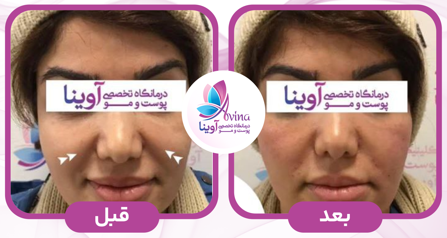 انواع روشهای جوانسازی و ترمیم پوست