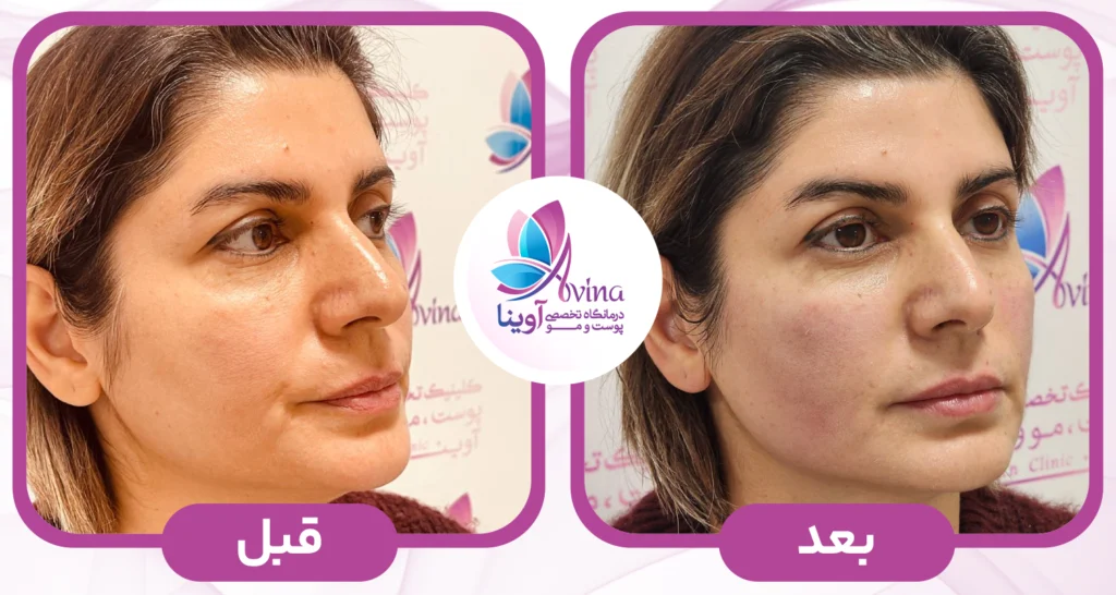هایفوتراپی در کلینیک آوینا