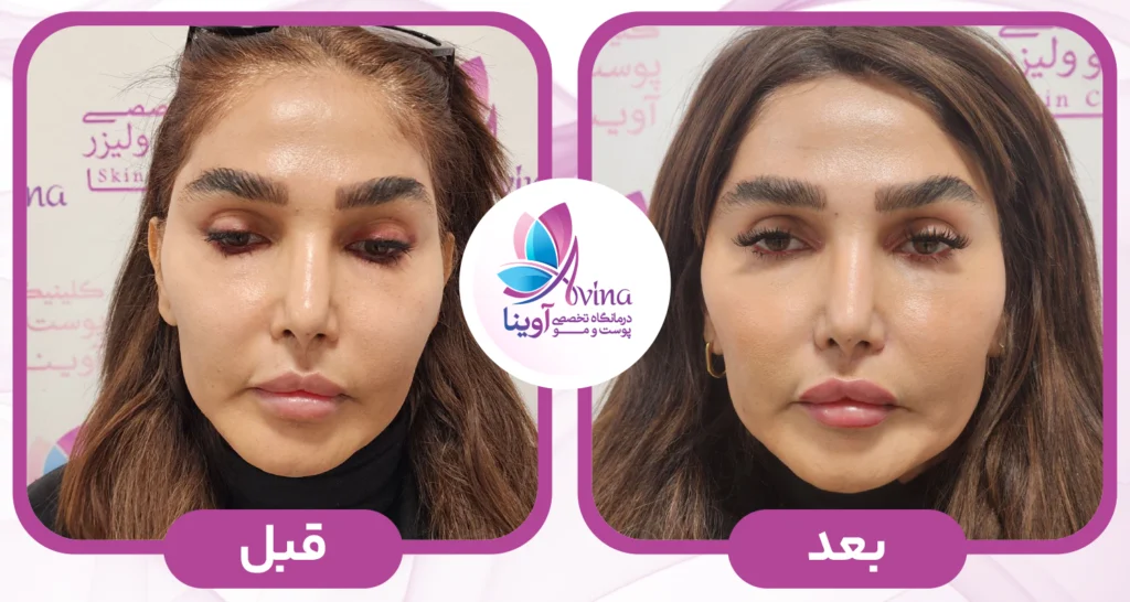 مزوژل پروفایلو در کلینیک آوینا