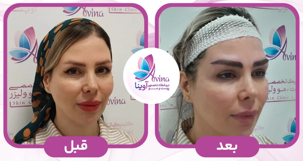 نکاتی که باید قبل از کاشت ابرو بدانید!