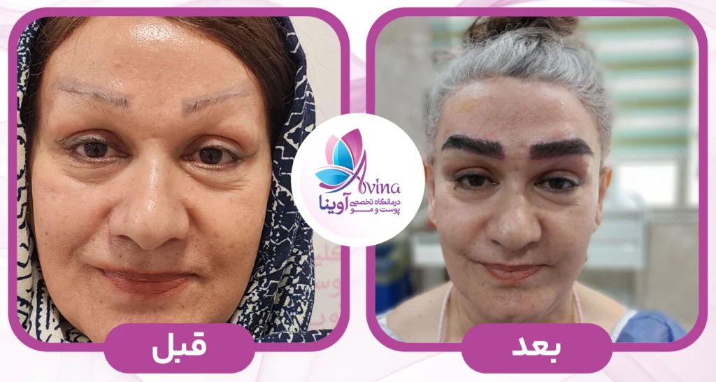 کاشت ابرو در کلینیک آوینا