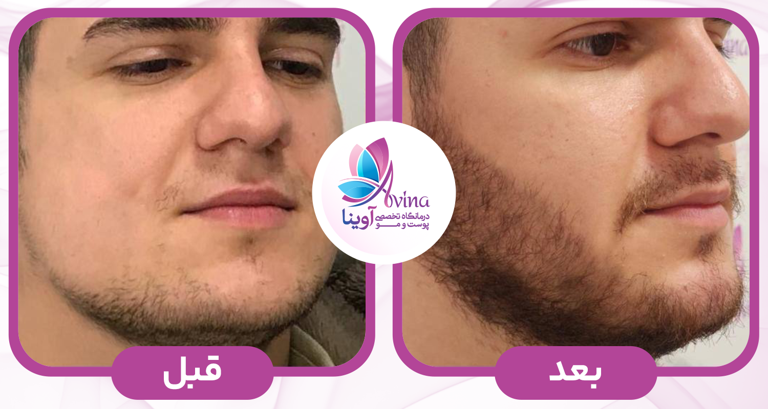 کاشت ریش در کلینیک آوینا