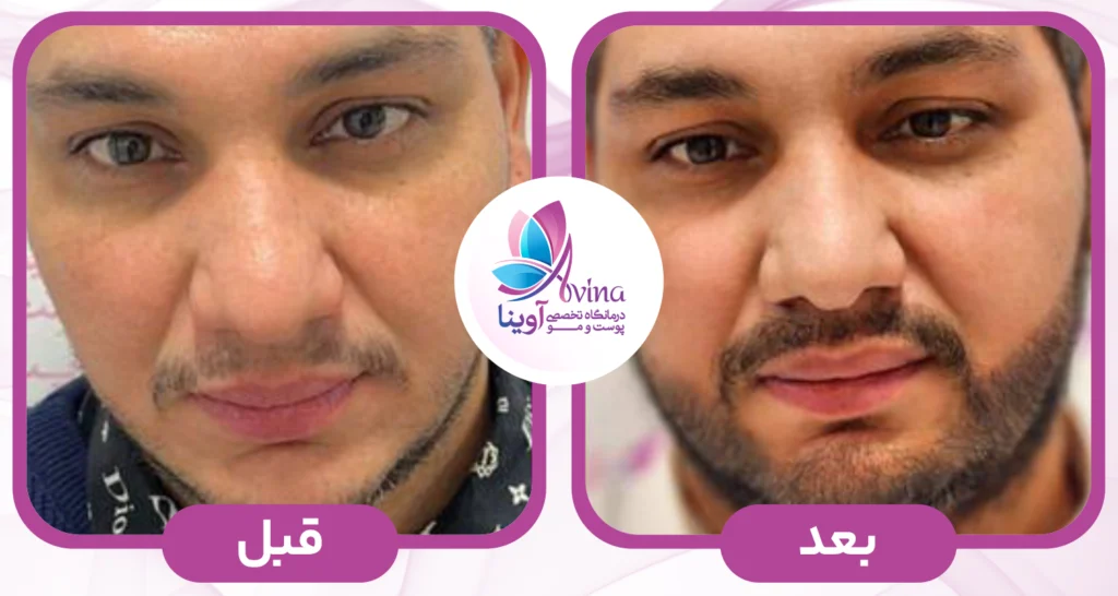 کاشت ریش در کلینیک آوینا