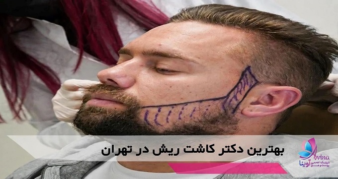 بهترین دکتر کاشت ریش در تهران