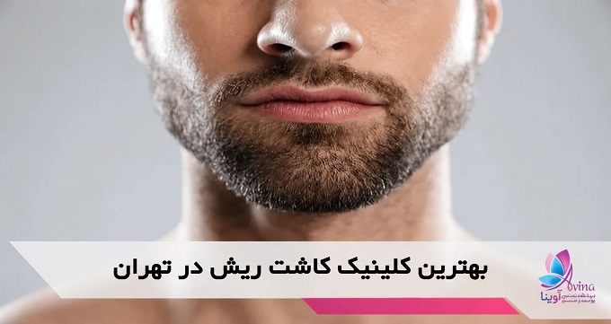 بهترین کلینیک کاشت ریش در تهران