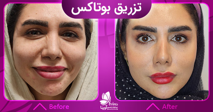 تزریق بوتاکس