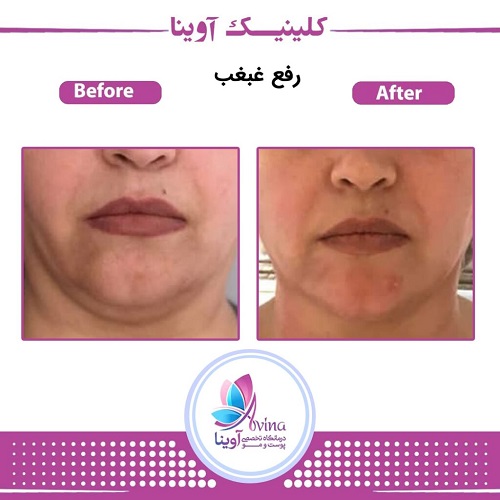 نمونه کار بوکال فت در کلینیک اوینا