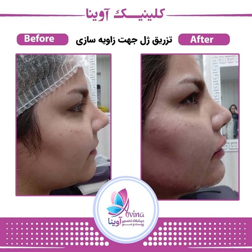 نمونه کار بوکال فت در کلینیک اوینا