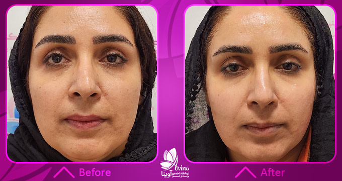 نمونه کار پاکسازی پوست در کلینیک آوینا
