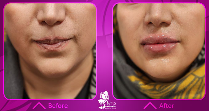 نمونه کار تزریق فیلر در کلینیک آوینا