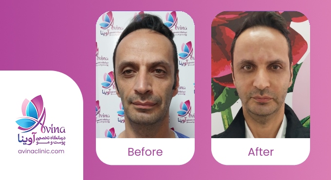 نمونه کار تزریق چربی در آوینا