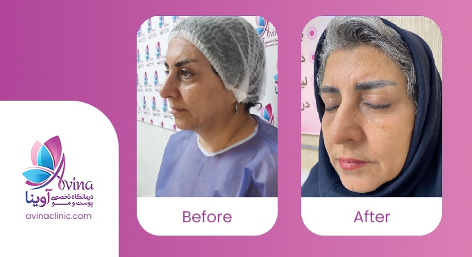 نمونه کار تزریق چربی در آوینا