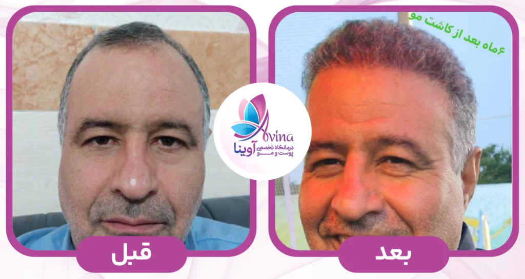 نمونه کار کاشت مو در کلینیک آوینا