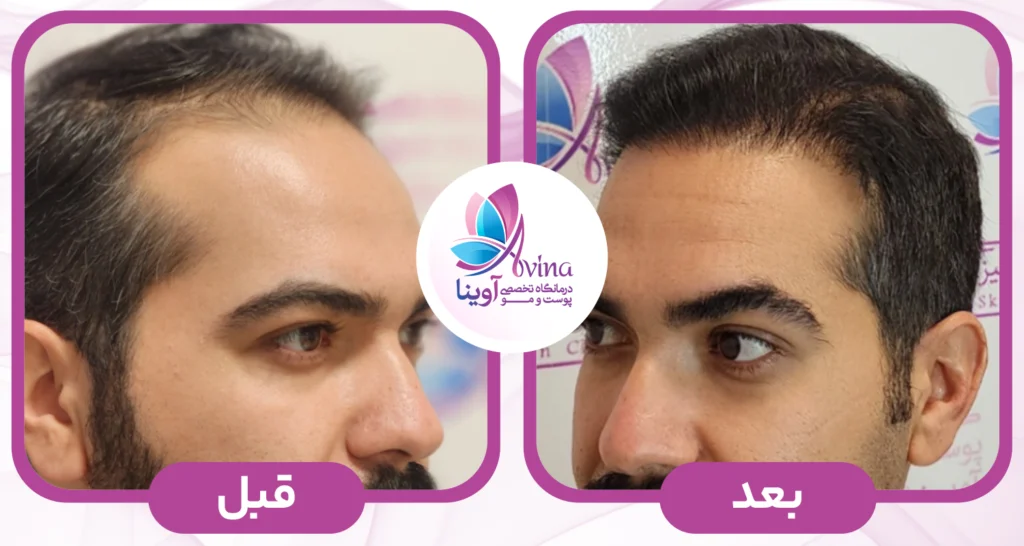 نمونه کار کاشت مو در کلینیک آوینا