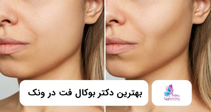 بهترین دکتر بوکال فت در ونک