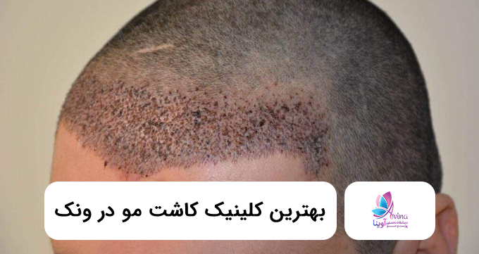 بهترین کلینیک کاشت مو در ونک 💗【سال1405】⚡