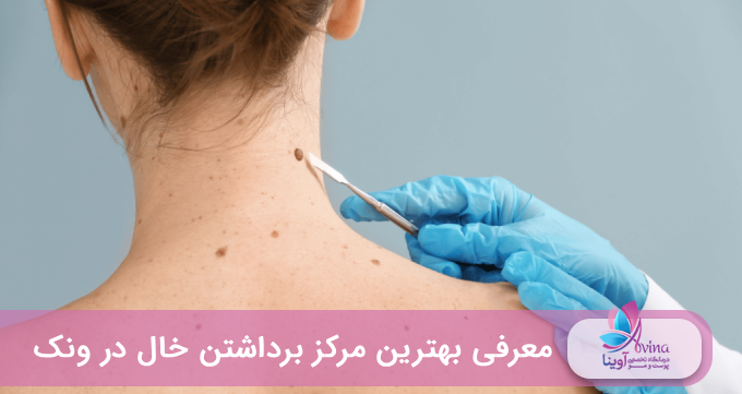 بهترین مرکز برداشتن خال در ونک ⭐【سال1405】❤️