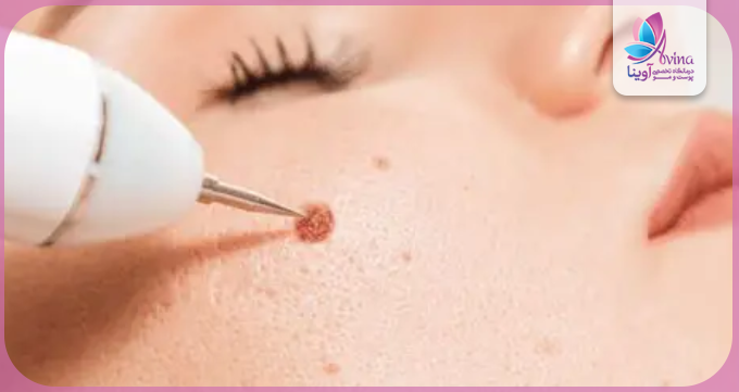 روشهای مختلف برداشتن خال در کلینیک آوینا